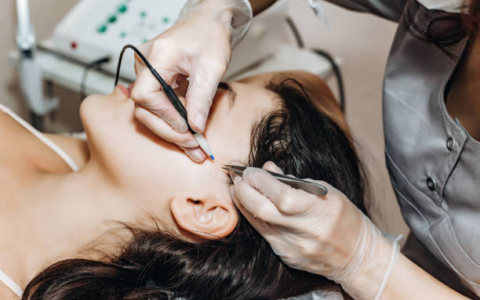 The process of permanent removal of unwanted facial hair using an electroepilation device and tweezers.