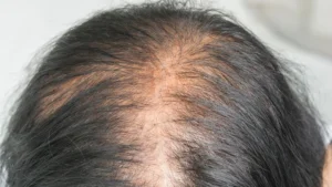 Scalp Thinning