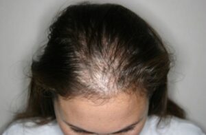 Female Front Thinning