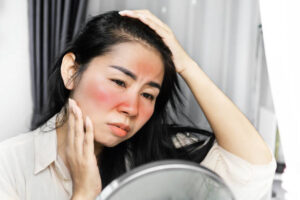Rosacea